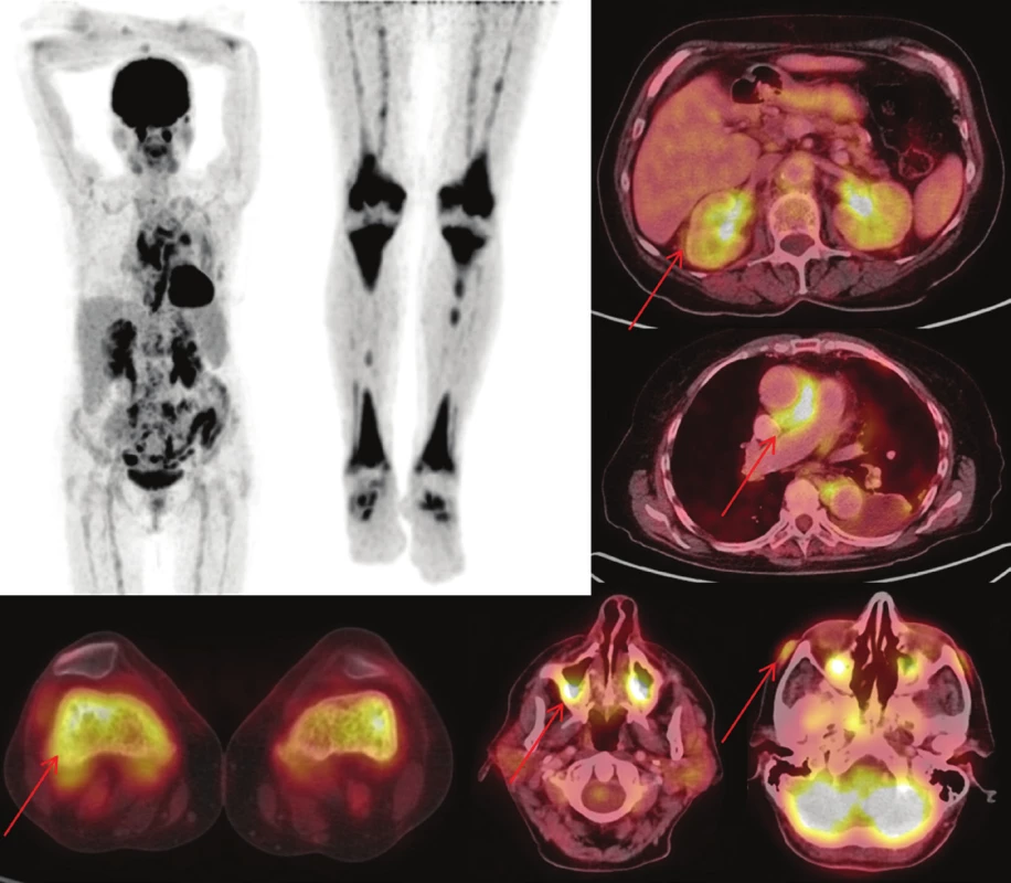 (vlevo) Sumarizace nálezů <sup>18</sup>F-FDG
PET/CT vyšetření u pacienta č. 3. Černobílé
MIP projekce ukazují rozsah snímání,
odráží i rozsah kostního postižení. Fúzované
obrazy pak ukazují detaily retroperitoneálního,
kardiovaskulárního, kostního,
paranasálního, orbitálního a kožního postižení.