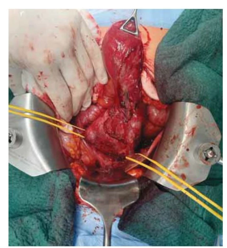 Operace: exstirpace ložiska s přilehlým žlučníkem
a žlučovými cestami.<br>
Fig. 5. Surgery: extirpation of the lesion with the adjacent gallbladder
and bile ducts.