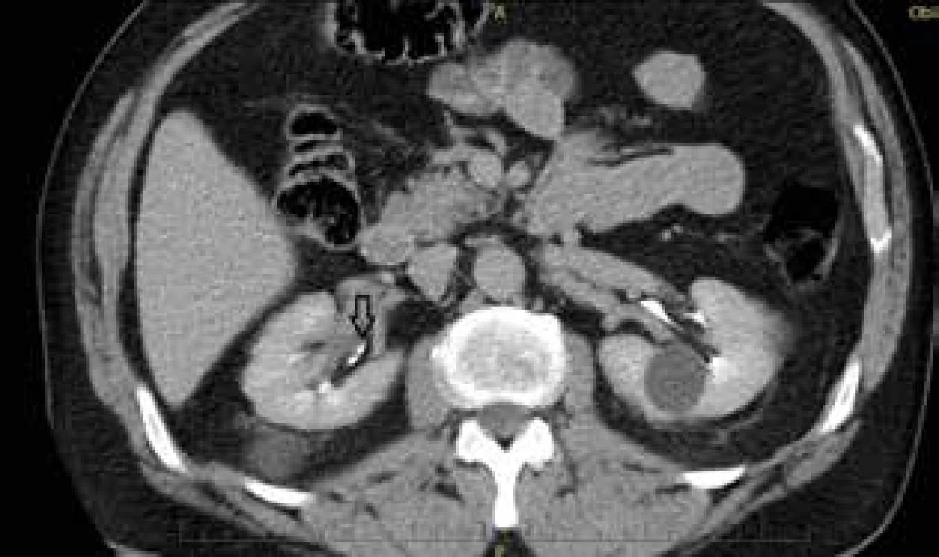 Uroteliální karcinom pánvičky pravé ledviny – CT <br>
Fig. 10: Urothelial carcinoma of the renal pelvis of the right
kidney − CT