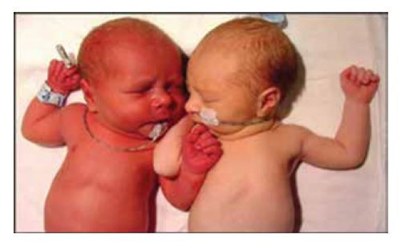 Pletorický vzhled novorozence (vlevo) při polycytemii
– komplikace protrahované placentární transfuze