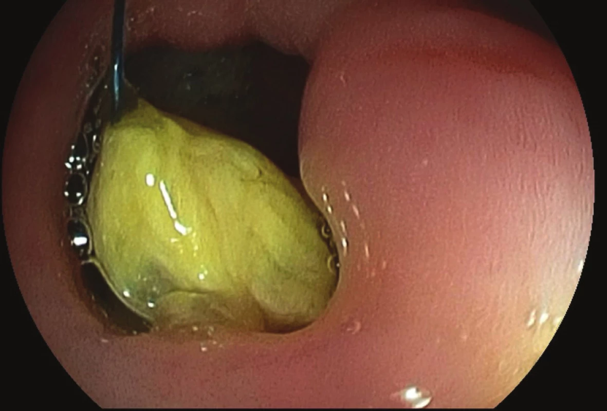 Gastroskopie po LGCP s nálezem bezoáru kolem
stehu<br>
Fig. 1: Gastroscopy with finding of bezoar around the
sewing material