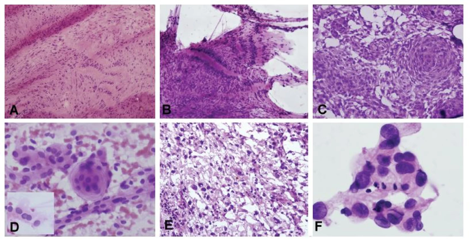 (A, B) Tumor pontocerebelárneho uhla u 53-ročného muža. V zmrazenom reze bola zachytená lézia bohatá na kolagénnu matrix a vretenitými bunkymi
s hyperchrómnymi pretiahnutými jadrami s naznačeným rytmickým/palisádujúcim usporiadaním (A). V náterovej cytológii prítomné iba zhluky tkaniva (žiadne
izolované bunky) zloženého z vretenitých buniek s tmavými jadrami, palisádovanie však bolo ložiskovo ešte výraznejšie ako v zmrazenom reze (B). Peroperačná
a definitívna diagnóza: schwannóm. (C, D) Tumor pontocerebelárneho uhla u 48-ročnej ženy. V zmrazenom reze je zachytená solídna proliferácia epiteloidných
buniek, s naznačenými vírovitými formáciami (C). V náterovej cytológii monotónna blandná populácia epiteloidných kohezívnych buniek (spojené širokým
pruhom cytoplazmy), ložiskovo s typickým vírovitým usporiadaním a jadrovými pseudoinklúziami (vložený obrázok) (D). Peroperačná diagnóza: meningióm.
Definitívna diagnóza: meningoteliálny meningióm, grade I. (E, F) 62-ročná žena so solídno-cystickým tumorom hemisféry mozočka. V zmrazenom reze bola
zachytená nádorová lézia tvorená bunkymi s vakuolizovanou cytoplazmou a atypickými hyperchrómnymi jadrami (E). V náterovej cytológii kohezívne fragmenty
tvorené epiteloidnými bunkami s atypickými jadrami a jemne vakuolizovanou cytoplazmou (F). Peroperačná a definitívna diagnóza: hemagioblastóm.