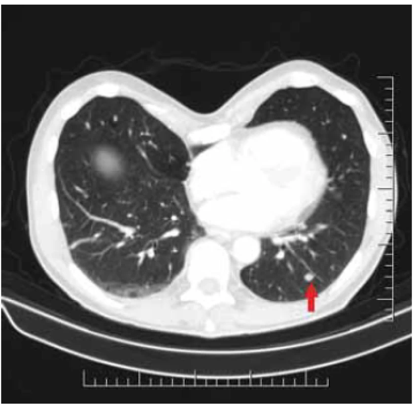 Metastases in pulmonary
parenchyme.<br>
Obr. 5. Metastázy v pľúcnom
parenchýme.