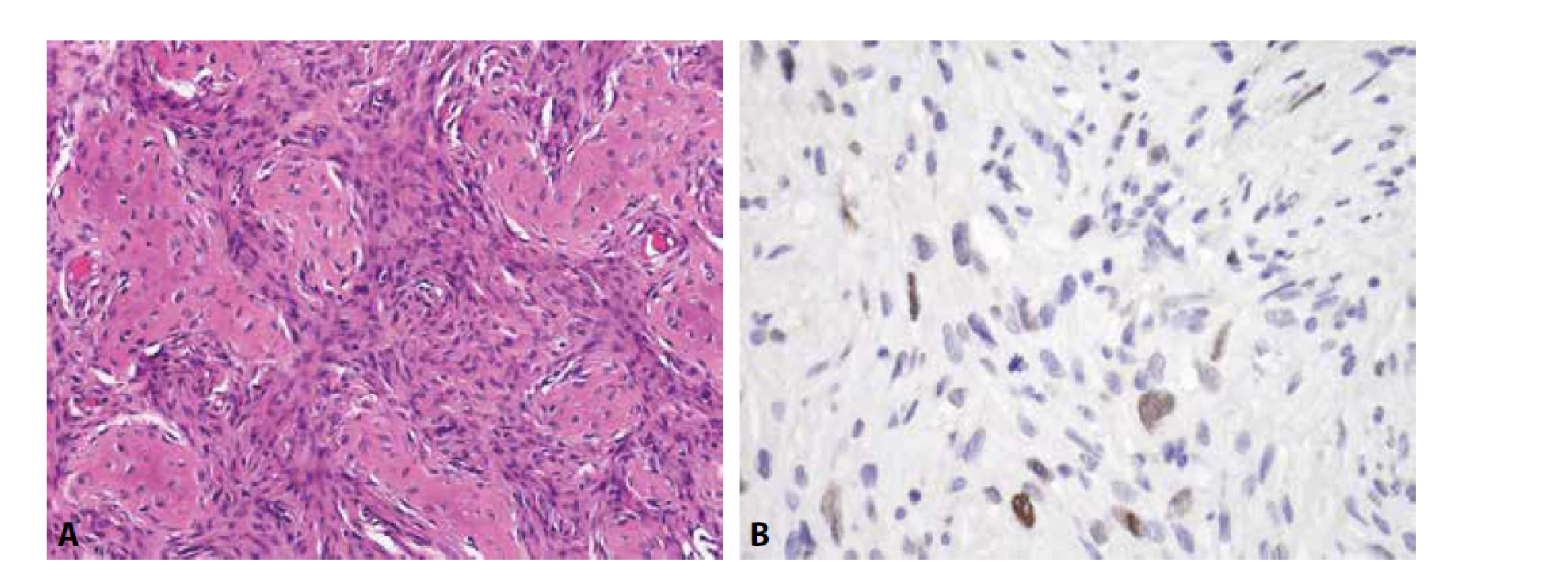 Low-grade centrální osteosarkom. A) oproti fibrózní dysplázii je tumor celulárnější (H&E); B) sporadická exprese MDM2 v oválných
buňkách (zvětšení x 200).