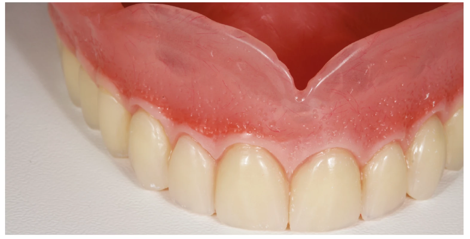Zhotovená horní totální
náhrada<br>
Fig. 4
The upper complete denture