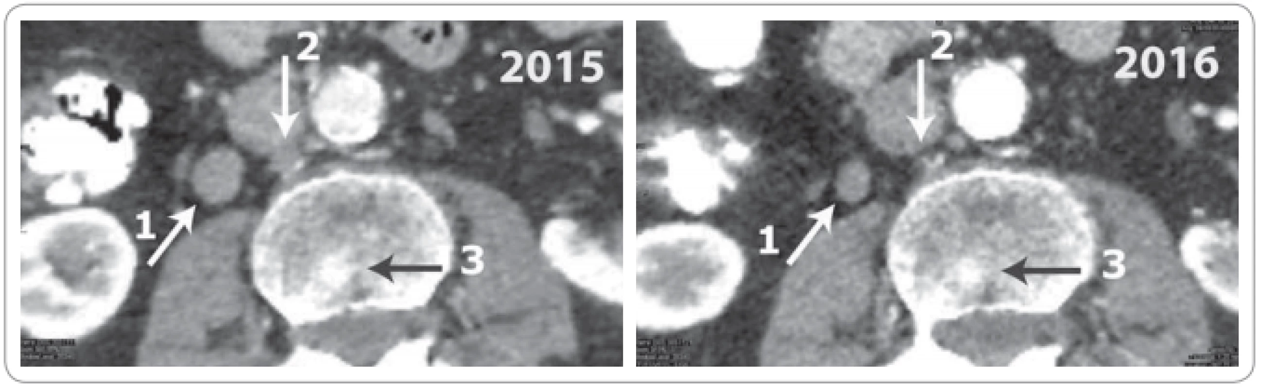 Abdominal CT scan in 2015 (left panel) and 2016 (right panel).