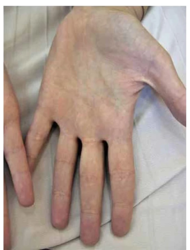 Xanthoma striatum palmare u 30leté nemocné
s ulcerózní kolitidou a primární sklerotizující cholangitidou