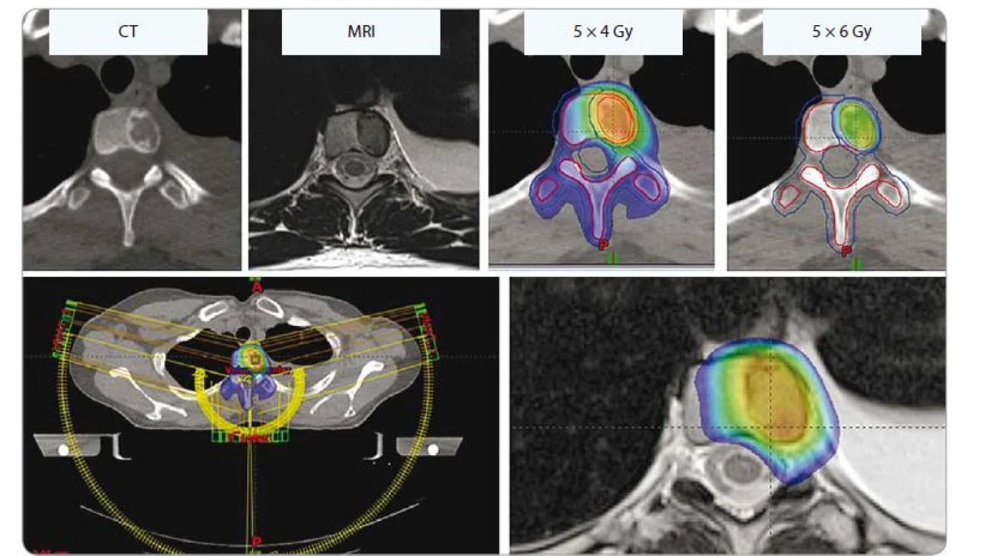 Solitární metastáza v obratli Th6 u 44leté pacientky s lobulárním karcinomem levého prsu. Dávka 5 × 4 Gy na celý obratel,
technikou SIB navýšena dávka do oblasti metastázy na 5 × 6 Gy.<br>
SIB – simultánní integrovaný boost, Gy – Gray, CT - počítačová tomografie, MRI – magnetická rezonance