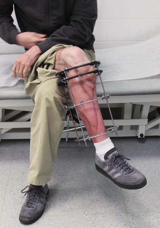 The periosteal part of the MFC flap was fixed and
stabilised in tibia defect with Ilizarov fixator. Six weeks after the
final reconstructive procedure, the patient was capable of full
range of motion in the knee