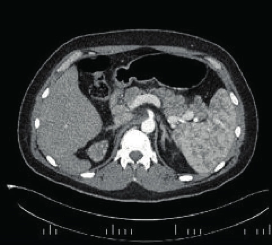 CT brucha s obrazom akútnej pankreatitídy