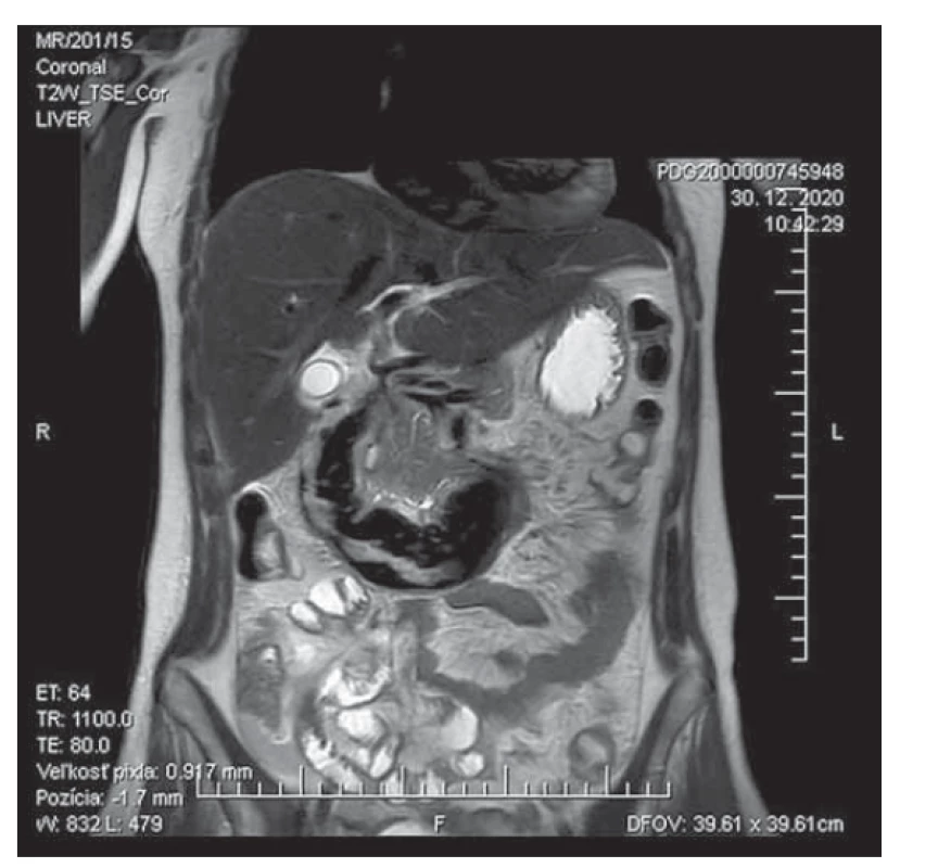 MR obraz spontánneho intramurálneho
hematómu duodena – dlhá dilatácia duodena s atypickými
nehomogénnymi pruhovitými intraluminálnymi
hyperintenzitami charakteru hemoragických koagúl.<br>
Fig. 3. MRI scan of a spontaneous intramural duodenal
hematoma – long dilatation of the duodenum with atypical
inhomogeneous striated intraluminal hyperintensities
characteristic for intraluminal clot.