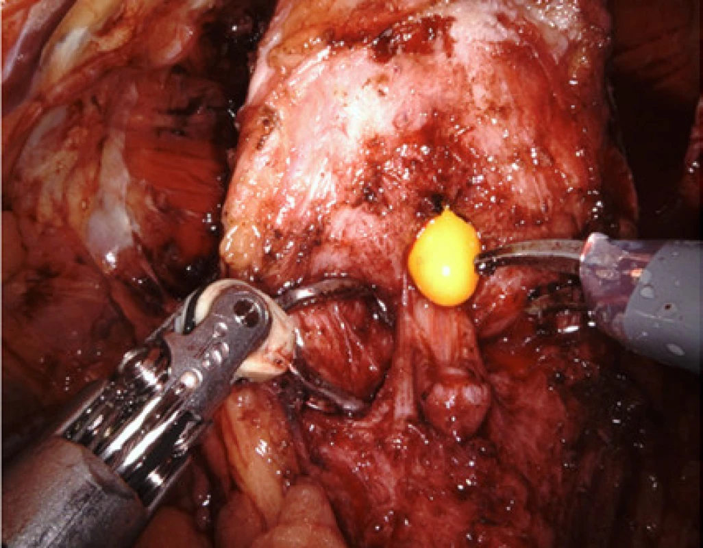 Na snímku je vidět vtažení cévky do prostaty
tak, aby byla přístupná zadní strana hrdla k odstřižení<br>
Fig. 5. The catheter has been retracted into the prostate
in order to make the posterior aspect of the bladder neck
accessible for dissection 