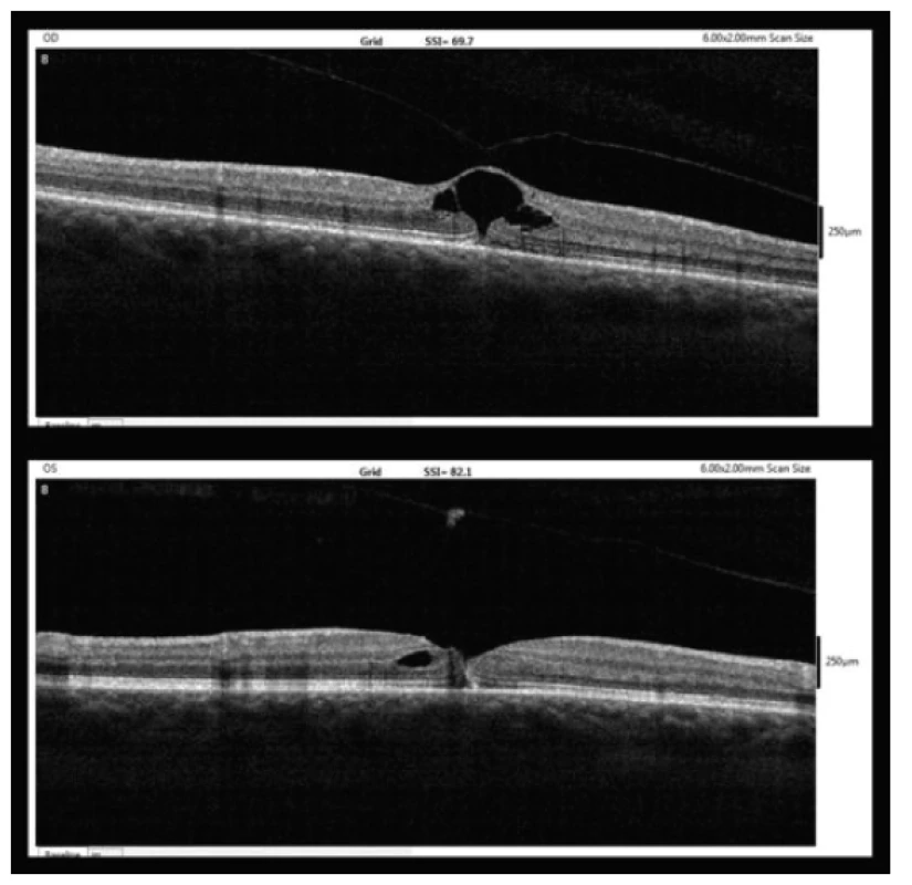 OCT findings one week after MH diagnosis (upper – right
eye, lower – left eye)