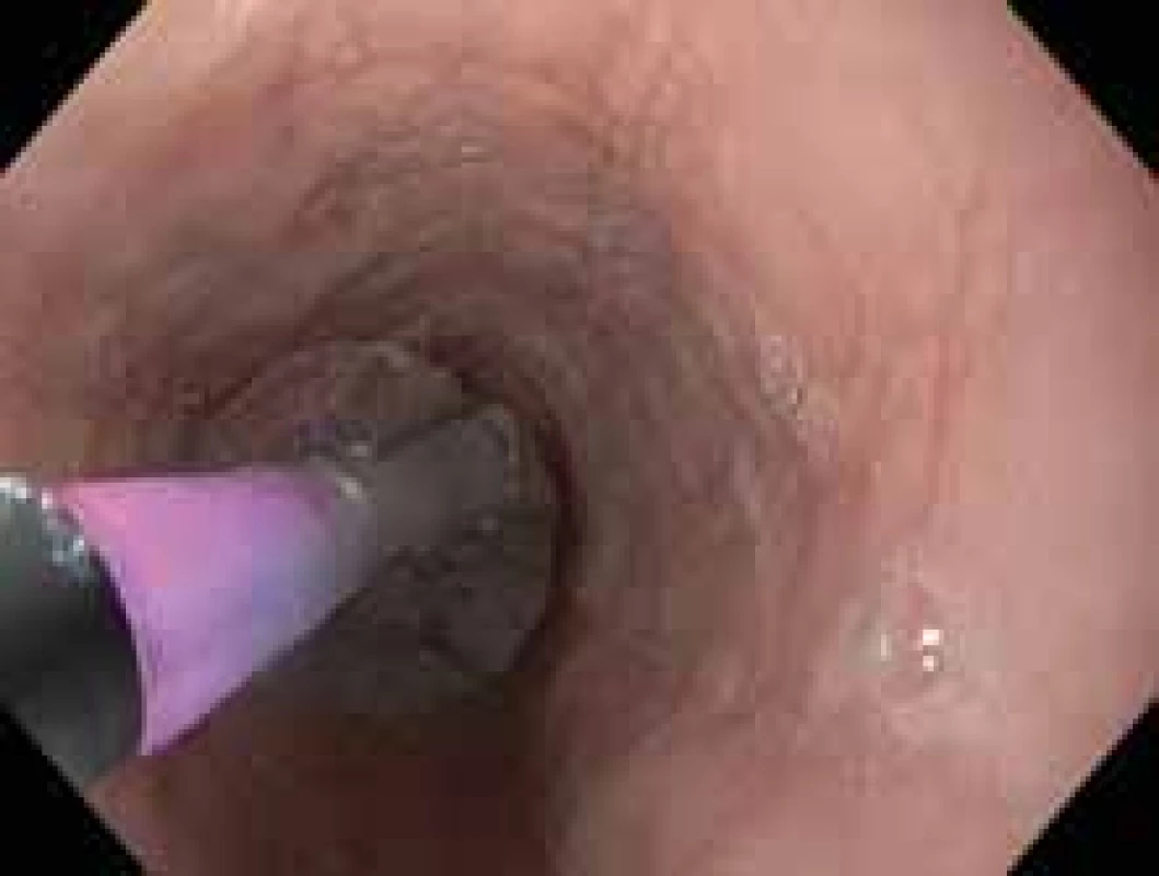 Pneumatická dilatace stenózy jícnu.<br>
Fig. 2. Pneumatic dilation of esophageal stenosis.