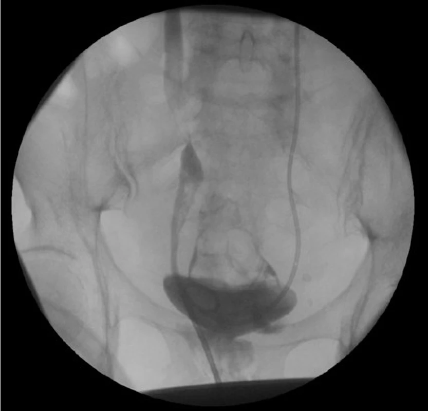 Ascendentní ureterografie s nálezem leaku kontrastní látky<br>
Fig. 4. Leakage of contrast agent during retrograde
ureterography