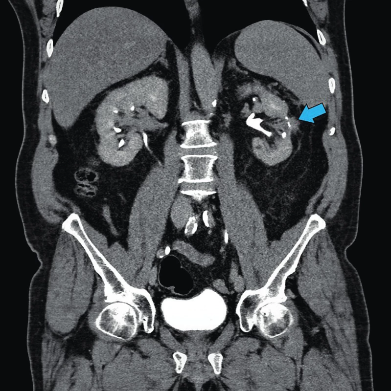 Pooperační komplikace – CT obraz úniku moči ze
středního kalichu levé ledviny