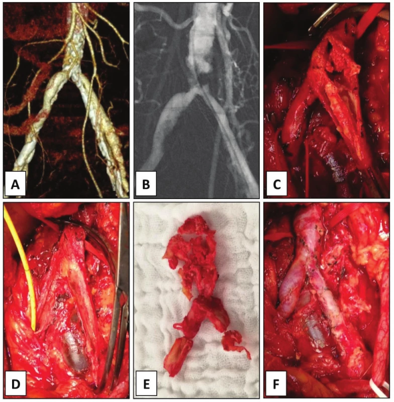 Endarterectomy of aortic bifurcation and common
iliac arteries, case 7.