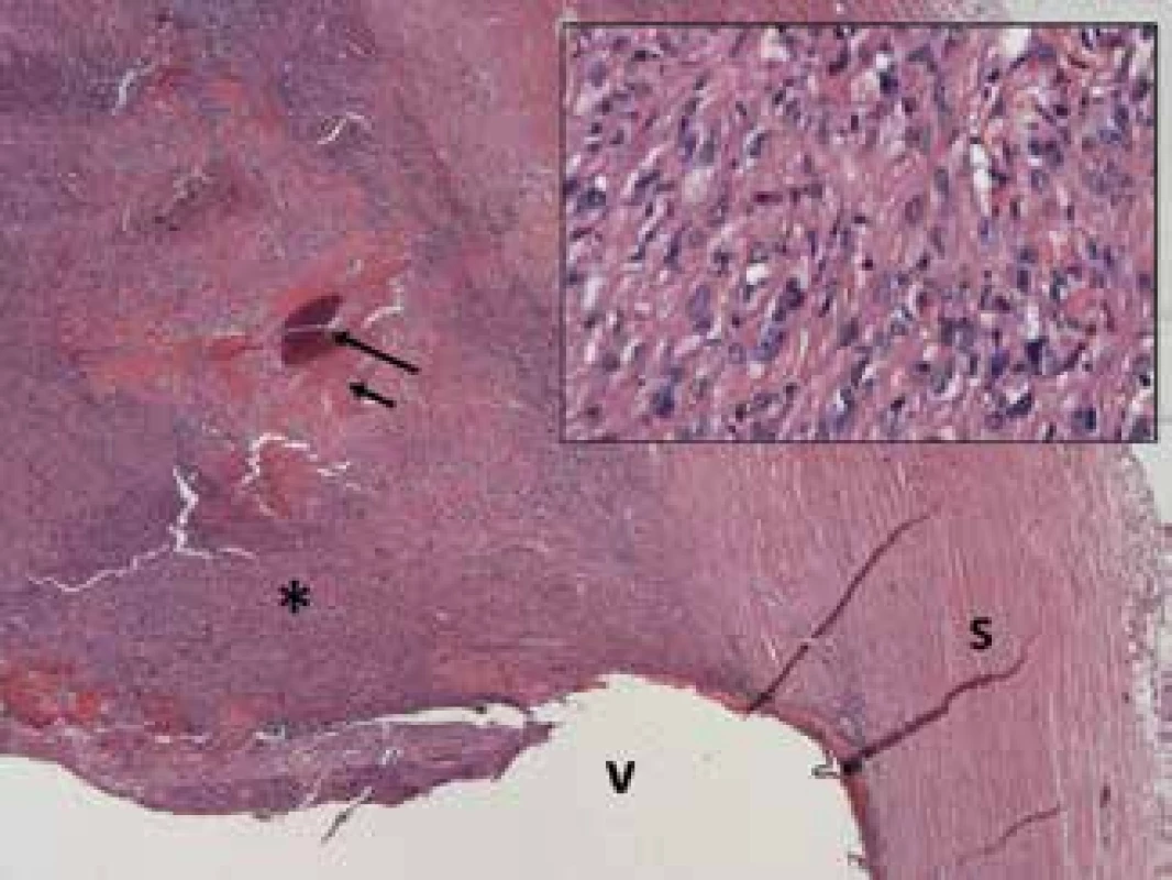 Neurofibróm rastúci vo vnútri očnej gule (*)
zložený z pretiahnutých buniek s jemne vákuovou cytoplazmou a vezikulovanými jadrami (inzercia), fokálne s
tvorbou osteoidu a osifikácie (krátka a dlhá šípka); sclera
(s), vitreus (v). Hematoxylín a eozín - 25x, detail - 200x
