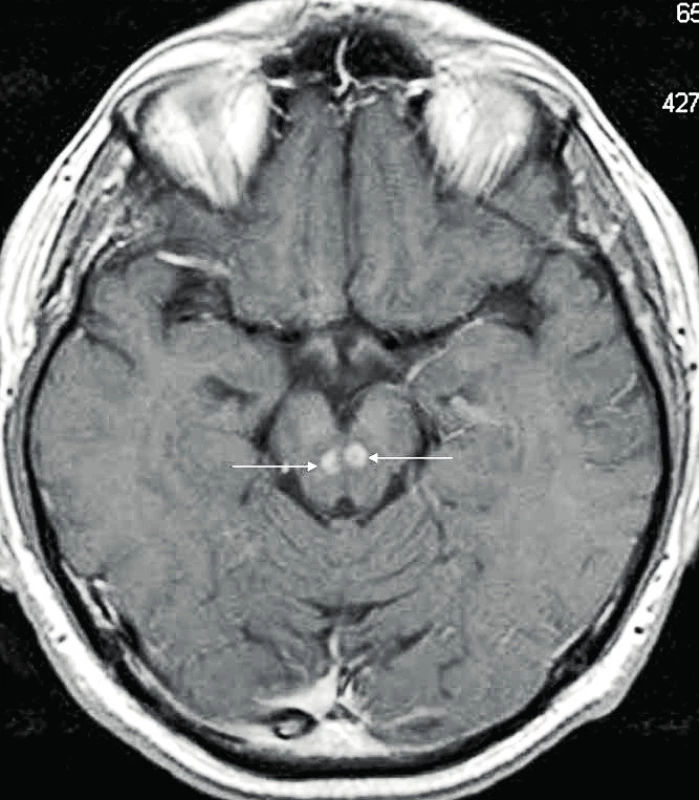 MR mozku u pacienta s ECD – zachycena dvě ložiska ECD