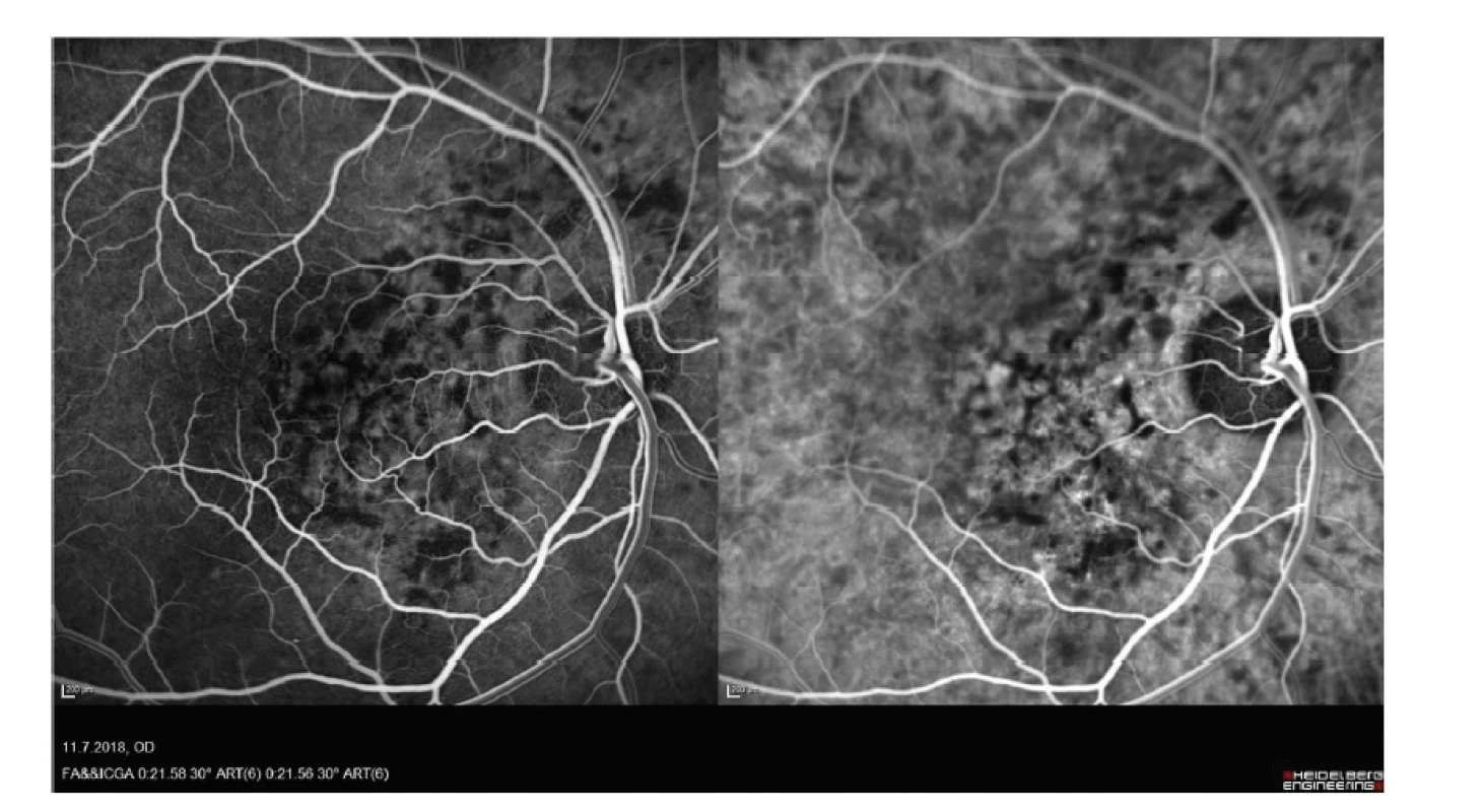Snímek fluorescenční angiografie a angiografie s indocyaninovou zelení hemangiomu
cévnatky