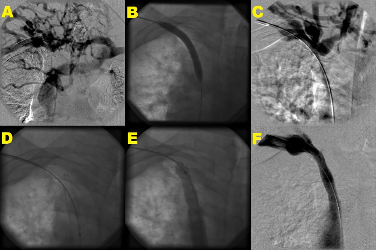 Angioplastika a stenting v. brachiocephalica vpravo<br>
 Angiografia centrálnych žíl s tesnou stenózou v. brachiocephalica vpravo, kolaterálne plnenie cestou v. brachiocephalica vľavo a v. cava superior. Angioplastika s 10 mm balónikom s nedostatočným efektom (B, C) s následnou implantáciou samoexpandovateľného stentu 14 × 40 mm s jeho dodilatáciou pomocou 12 mm balónika (D, E). Kontrolná angiografia s konečným výsledkom bez reziduálnej stenózy, bez plnenia kolaterál (F)