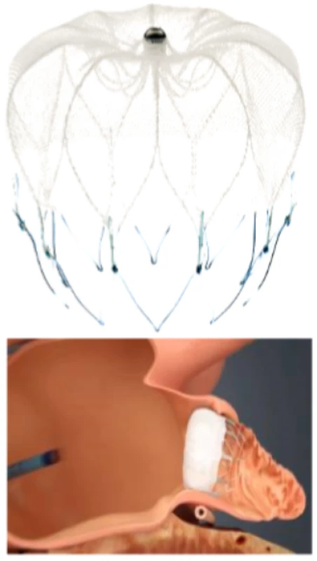Okludér Watchman a schéma jeho implantace do ouška levé síně (publikováno se souhlasem společnosti Boston Scientific)