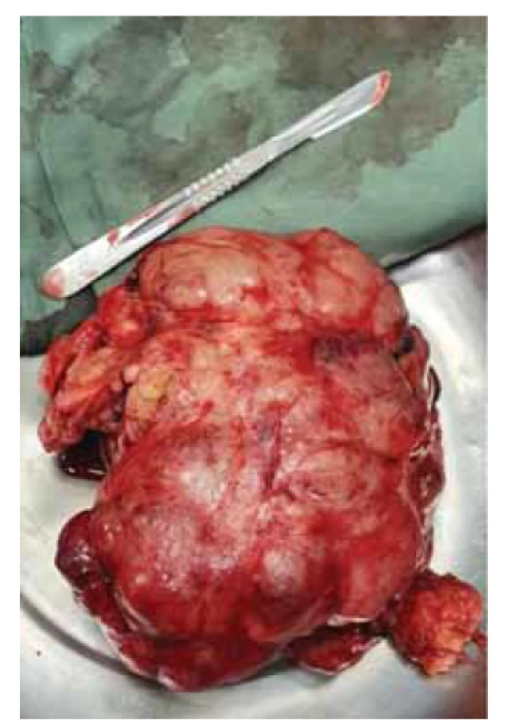 Výsledná velikost fibroadenomu
po enukleaci.<br>
Fig. 3. Final size of the fibroadenoma
after enucleation.