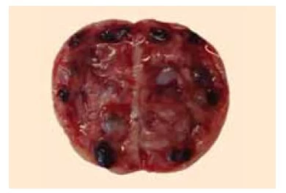 Rozpůlené ovarium s antrálními
folikuly v medule.<br>
Fig. 4. Bisected ovary with antral follicles
in the medulla.