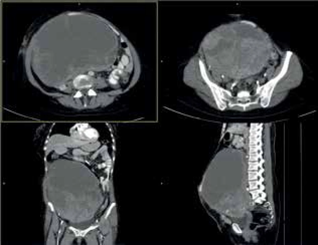 CTA obraz tumoru<br>
Fig. 8: CTA scan of the tumor