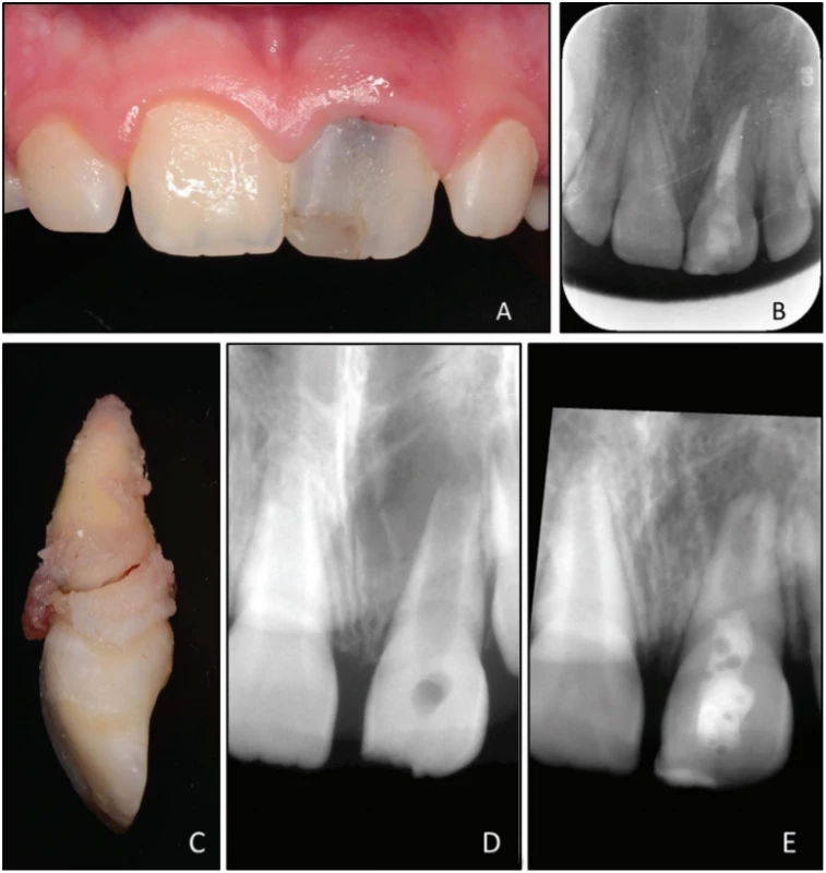 A Fotografie klinického stavu
21 měsíců po dokončení
endodontického ošetření
zubu 21; je přítomna šedavá
dyskolorace klinické korunky;
B intraorální rentgenový
snímek v apikálním zastavení
21 měsíců po endodontickém
ošetření;
C extrahovaný zub
21 s horizontální frakturou
kořene;
D upravený diagnostický
rentgenový snímek zubu
21 před ošetřením
maturogenezí;
E upravený intraorální
rentgenový snímek zubu
21 před endodontickým
ošetřením<br>
Fig. 1
A Clinical photograph taken
during follow-up 21 month
after root canal treatment;
grayish discoloration of tooth
21 is clearly visible;
B intraoral radiograph taken
during follow-up 21 month
after root canal treatment;
C extracted tooth 21 with
oblique fracture,
D aligned preoperative
intraoral radiograph
of tooth 21;
E aligned postoperative
intraoral radiograph of tooth
21 before root canal treatment