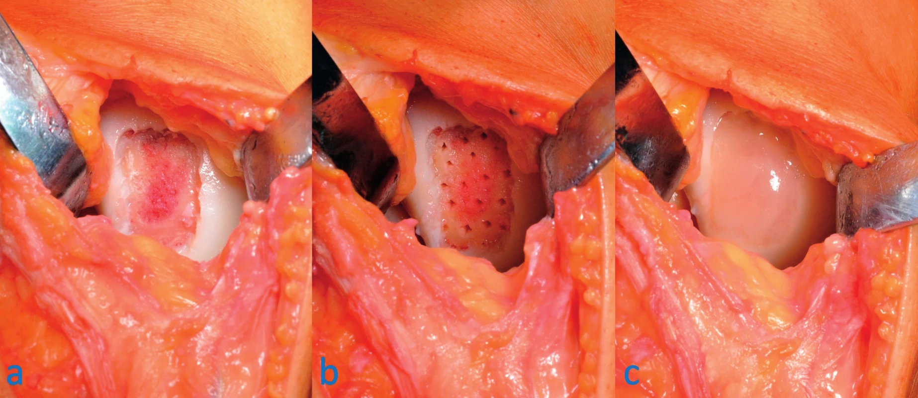 Ošetření chondrálního defektu mediálního kondylu femuru pravého kolene modifikovanou AMIC technikou: a – ze spodiny a okrajů
defektu odstraněna poškozená chrupavka, b – na spodině defektu provedeny mikrofraktury pomocí šídla, c – výsledný stav po implantaci
scaffoldu a zalití okrajů tkáňovým lepidlem