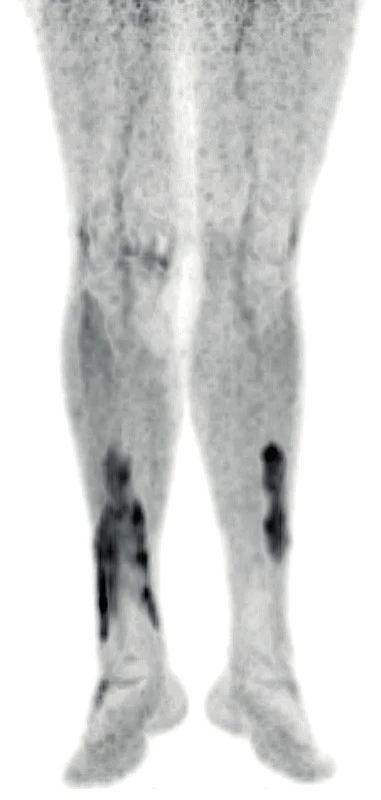 PET/CT zobrazení dolních končetin pacienta s xantogranulomem
z roku 2019 – část 1