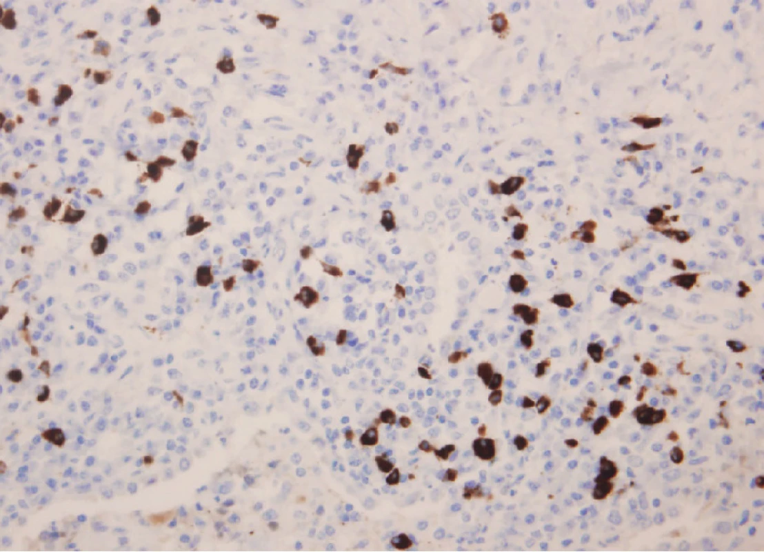 Imunohistochemický nález u pacienta s IgG4 asociovaným plicním
onemocněním. Průkaz IgG4+ plazmocytu (400krát)
