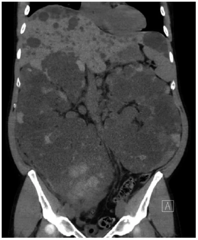Stejná ledvina na předoperačním zobrazení MRI
(vpravo, zdroj: archiv autora) <br> 
Fig. 2. Same kidney on MRI before surgery (source:
author)