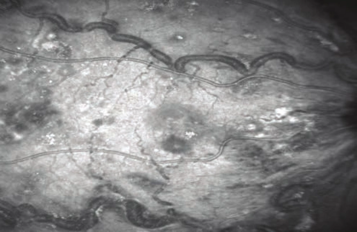 Snímek z  videa fundu na optické koherenční tomografii pravého oka: makula prosáklá, hemoragie a tvrdé exsudáty, výrazná dilatace a  tortuozita cév s  patrnými bělavými
hmotami v lumen cév