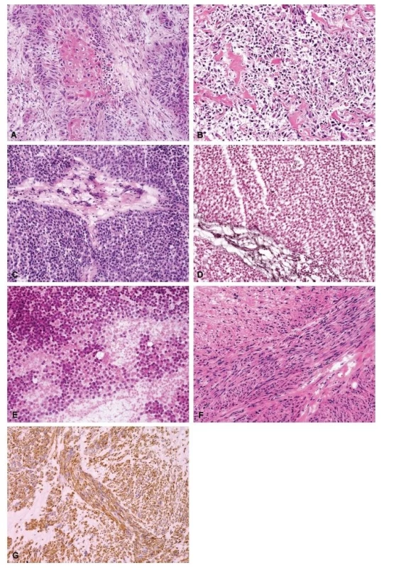 (A) Metastáza dlaždicobuněčného karcinomu do proximálního
femuru, primární lokalizace: děložní čípek (HE, 200x).
(B) Konvenční high-grade osteosarkom, osteoblastická varianta
v proximální tibii u 57letého muže (HE, 200x). (C) Ewingův
sarkom malé pánve u 21letého muže, v době diagnózy 24 cm
v největším rozměru (HE, 200x). (D) Ewingův sarkom, barvení na
retikulin dle Gömöriho (200x). (E) Ewingův sarkom, cytologický
preparát – otisk (HE, 200x). (F) Leiomyosarkom grade 2 na ventrální
straně bérce u 48leté ženy (HE, 200x). (G) Leiomyosarkom,
desmin, (200x).