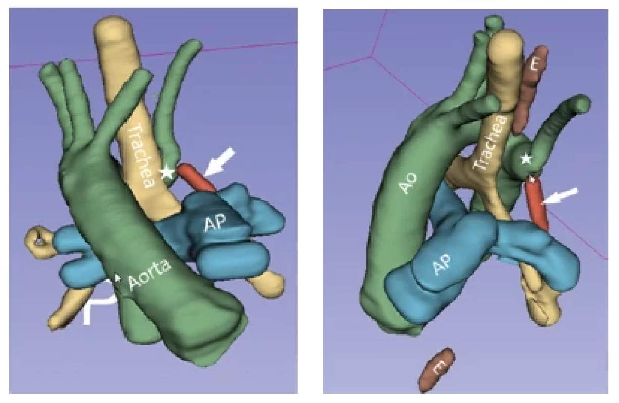 3D virtuálny „odliatkový“ model extrakardiálnych cievnych
štruktúr u 9-mesačného pacienta so symptómami inspiračného
stridoru a dysfágie. 3D model zobrazuje druhú najčastejšiu
variantu symptomatického aortálneho ringu: pravostranný aortálny
oblúk s Kommerelovým divertiklom s aberantne odstupujúcou
ľavostrannou arteriou subclaviou (označené bielou *). V oblasti
pred Kommerelovým divertiklom je malý priestor podmieňujúci
stenózu distálneho úseku priedušnice a ľavého hlavného bronchu,
ako aj významný útlak pažeráka (označený ako „E“). Na obrázku
vpravo je vidieť, že lumen pažeráka sa obnovuje až v kaudálnejšej
oblasti. Aortálny ring zužujúci priestor pre priedušnicu a pažerák
je kompletizovaný prostredníctvom „ligamentum arteriosum“
(pozostatok arteriálneho duktu), ktorý kedže nemá lumen, sa pomocou
CTA zobraziť nedá, no pre prehľadnosť je na 3D modeli dokreslený
tehlovočervenou farbou (ukazuje naň šípka). Na základe
analýzy 3D modelu bola naplánovaná kardiochirurgická operácia
s cieľom preťatia ligamentum arteriosum s cieľom otvorenia
aortálneho ringu a dosiahnutia tak odstránenia externého útlaku
na priedušnicu a pažerák. Obrázok vľavo: anteriórny pohľad.
Obrázok vpravo: pohľad zľava a mierne zhora.
Z kohorty 280 pacientov bolo CTA vyšetrenie vykonané
v 39 prípadoch (13,9%) u novorodencov, čo pri odhadovanej
ročnej incidencii cca 100–120 novorodencov s kritickými
vrodenými chybami srdca na Slovensku predstavuje cca
30–40percentný podiel využívania CTA u tejto skupiny pacientov.
Na druhej strane bola CTA zrealizovaná aj u 14 dospelých
pacientov s VCC, ktorí sú zatiaľ stále v starostlivosti
detských kardiológov.
Väčšina pacientov veku > 5 rokov nevyžadovala sedáciu
alebo celkovú anestéziu počas vyšetrenia. Výnimkou
bolo iba 10 pacientov s mentálnou retardáciou, úzkosťou
či klaustrofóbiou. Efektívne radiačné dávky pacientov
od novorodeneckého veku po štrnásty rok života (mediány
0,75–1,94 mSv) zodpovedali radiačným dávkam uvádzaným
pri využívaní najmodernejších CT prístrojov.(8)
Vyšší medián efektívnej radiačnej dávky 7,9 mSv sme zaznamenali
vo vekovej skupine pätnásť a viacročných pacientov.
V rámci prevencie zníženia onkogénneho potenciálu
kumulatívnych radiačných dávok najmä v skupine
pacientov s plánovanými opakovanými CTA vyšetreniami
bude v budúcnosti nutné zvažovať realizáciu CMR ako
alternatívnej zobrazovacej metódy, aj keď za cenu zníženej
kvality anatomického zobrazenia kardiovaskulárnych
štruktúr.