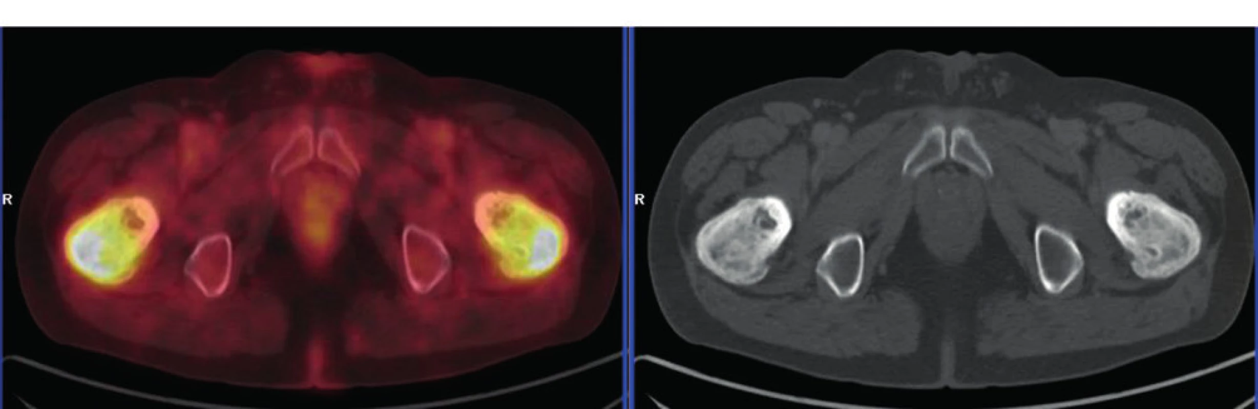 PET-CT zobrazení femurů u pacienta s ECD – axiální řez:
oba femury mají nepravidelnou, převážně sklerotickou strukturu
spongiózy s osteolytickými okrsky, v těchto místech je i vysoká
akumulace FDG