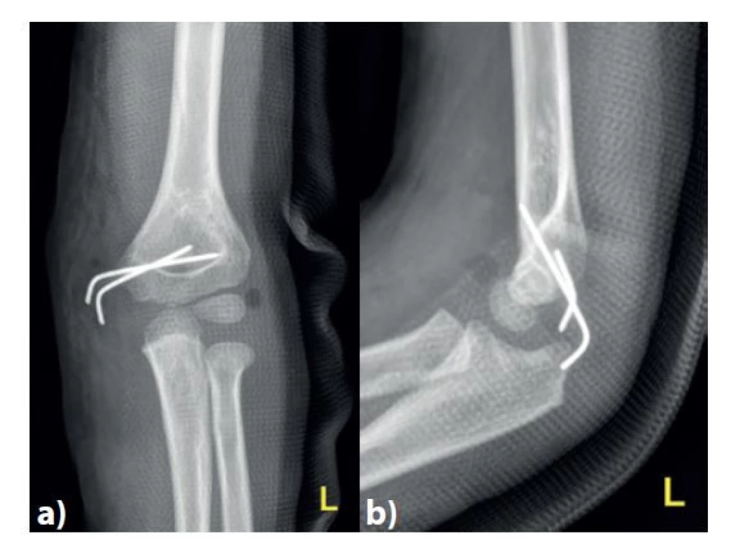 Kontrolní snímek po osteosyntéze dvěma divergentně
vedenými Kirschnerovými dráty v předozadní a)
a bočné b) projekci<br>
Fig. 5: Follow-up plain X-ray after osteosynthesis with two
Kirschner wires – anteroposterior a) and lateral b) views