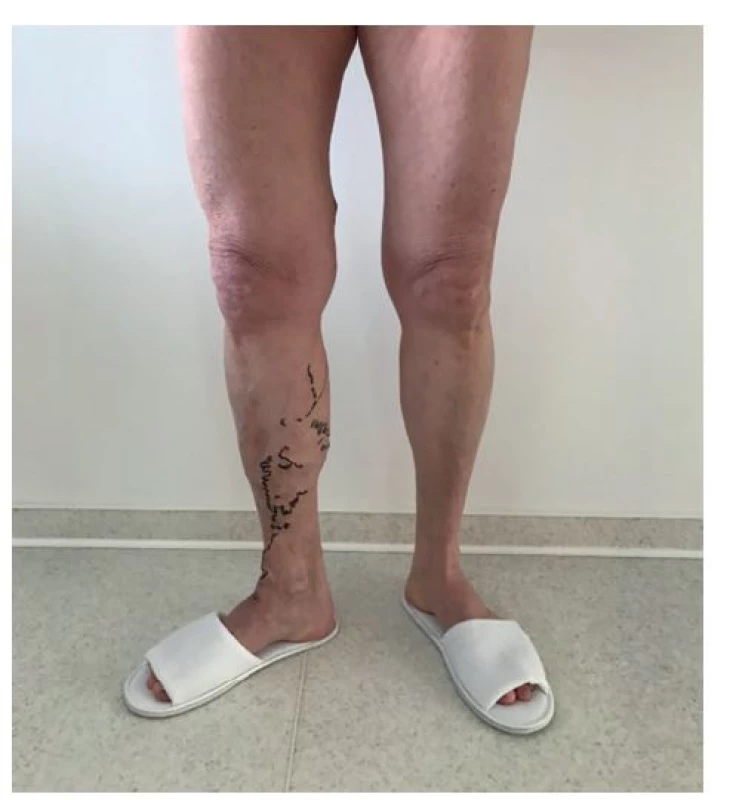 Insuficientní úseky žil vyznačené na kůži před operací<br>
Fig. 1: Insufficient vein sections marked on the skin before
surgery