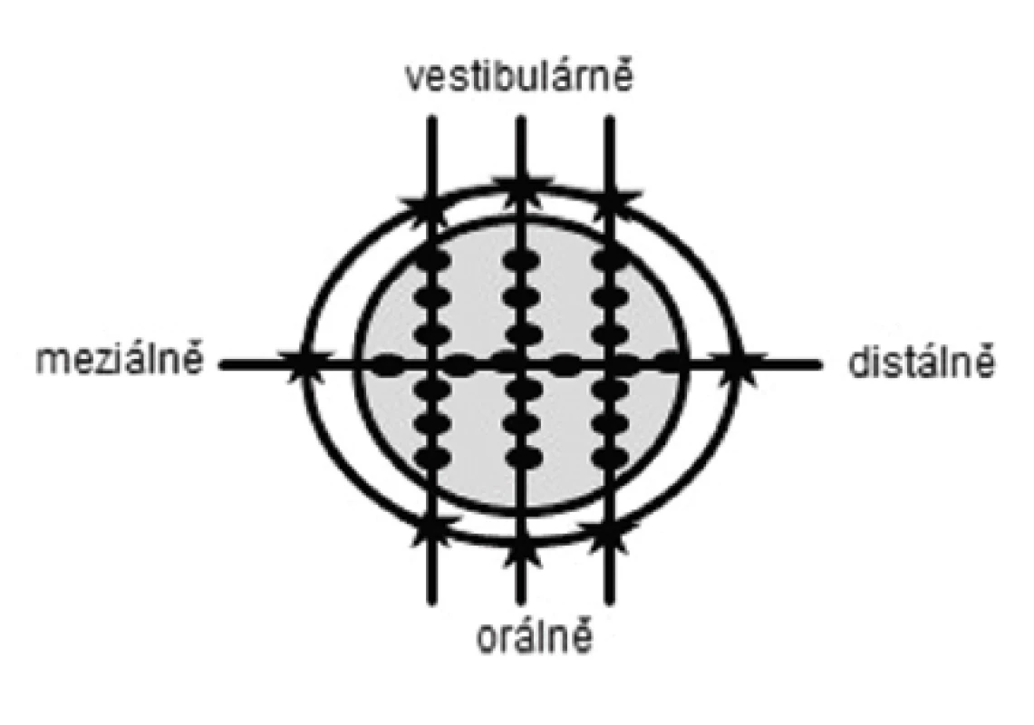 Způsob rozříznutí otisků při standardní preparaci (SP) a preparaci s okluzním isthmem (OP): ve
vestibuloorálním směru třikrát a v meziodistálním směru jedenkrát. Na každém řezu bylo provedeno měření na šesti místech na okluzní ploše (tečky), dvou místech na okrajích (hvězdičky) a dvou místech na axiálních stěnách (nezakresleno).
Fig. 3
Replicas sectioning plan for standard preparation design (SP) and preparation design with occlusal isthmus (OP): in the bucco-lingual direction (three times) and in the mesiodistal direction (ones). With measuring points occlusal (dots, six points each slice) marginal (stars, two points each slice) and axial (not marked, two points each slice)