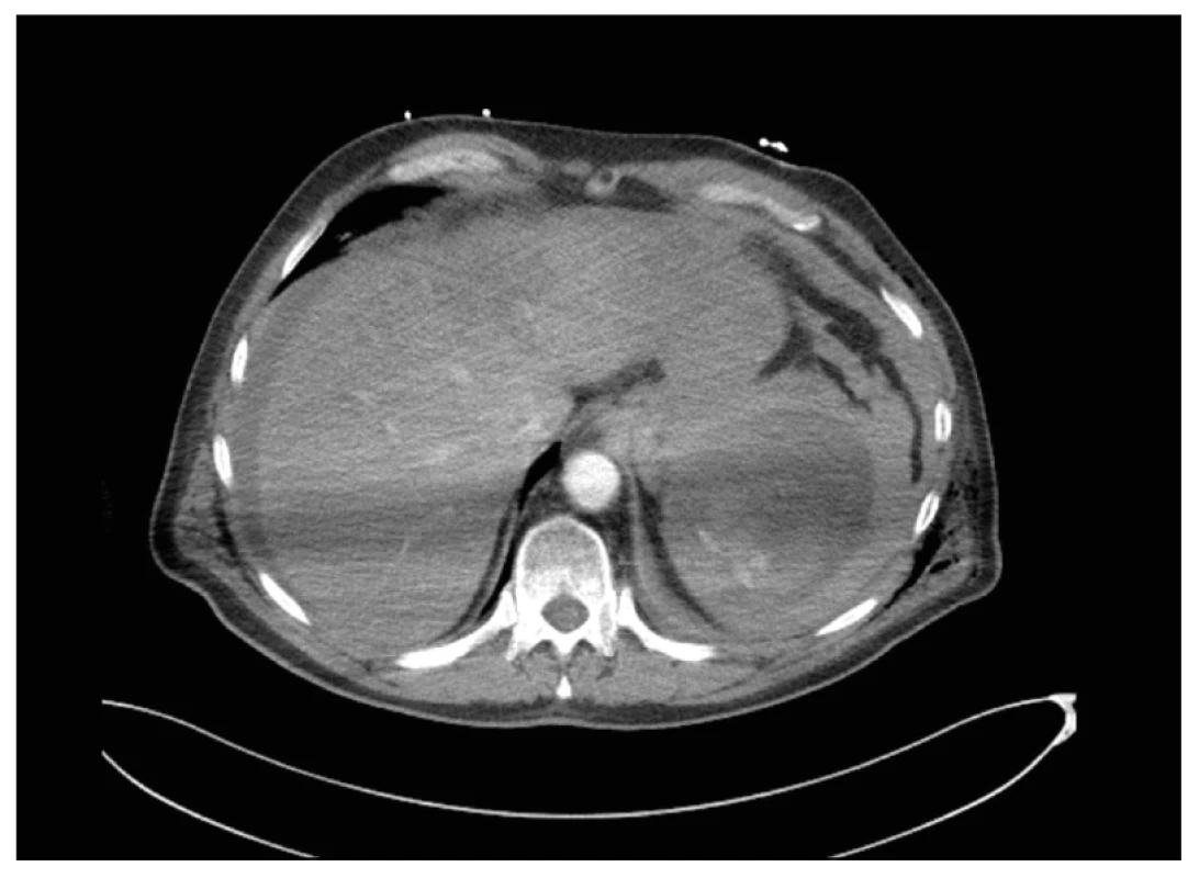 CT trupu po KPR. Transversální řez. Ruptura sleziny s hemoperitoneem, ve venózní fázi narůstající leak KL
