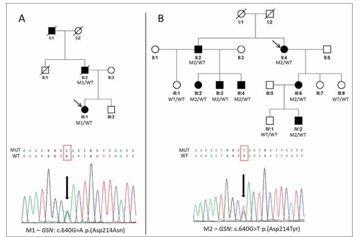Rodokmeny dvou rodin s hereditární gelsolinovou amyloidózou a detekované příčinné mutace.<br>
(A) Rodina slovenského původu s výskytem heterozygotní mutace M1 c.640G>A p.(Asp214Asn) v genu GSN a její sekvenogram.<br>
(B) Rodina českého původu s výskytem heterozygotní mutace M2 c.640G>T p.(Asp214Tyr) v genu GSN a její sekvenogram.<br>
Probandky jsou v jednotlivých rodinách označeny šipkami.<br>
GSN – gen gelsolin; M – mutace; WT – divoká alela<br>
Fig. 1. Pedigrees of two families with hereditary gelsolin amyloidosis and detected causal mutations.<br>
(A) Family of Slovak origin with identified heterozygous mutation M1 c.640G>A p.(Asp214Asn) in the GSN gene and its sequence
chromatogram.<br>
(B) Family of Czech origin with identified heterozygous mutation M2 c.640G>T p.(Asp214Tyr) in the GSN gene and its sequence
chromatogram. Probands are indicated by arrows.<br>
GSN – gelsolin gene; M – mutation; WT – wild type