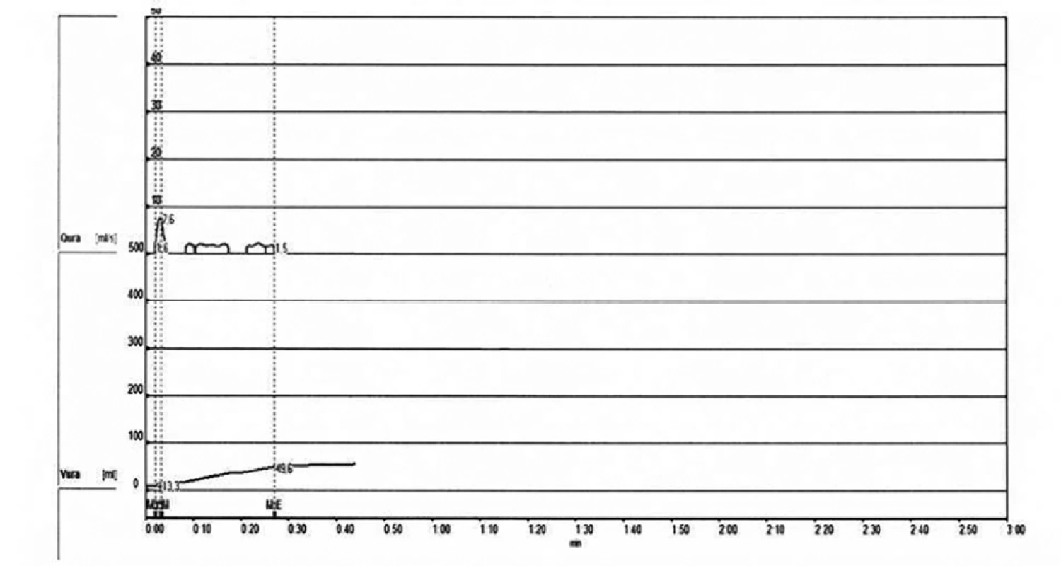 Uroflowmetrie – malý objem močení<br>
Fig. 1. Uroflowmetry – small volume of urine