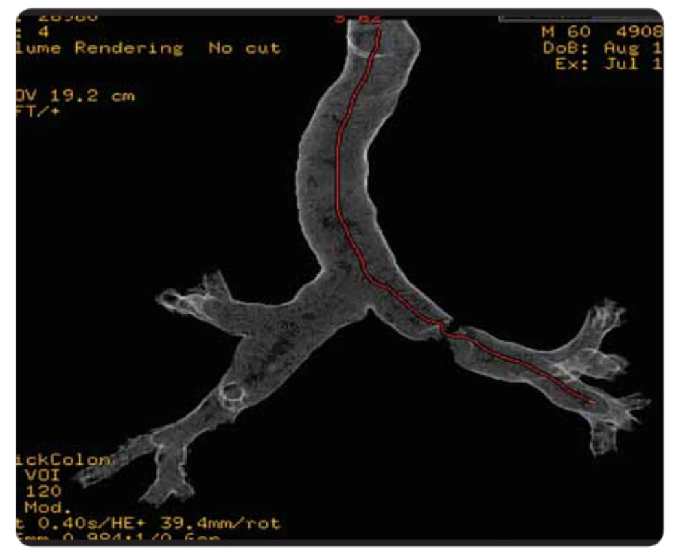 3D-rekonstrukce CT virtuální bronchoskopie.