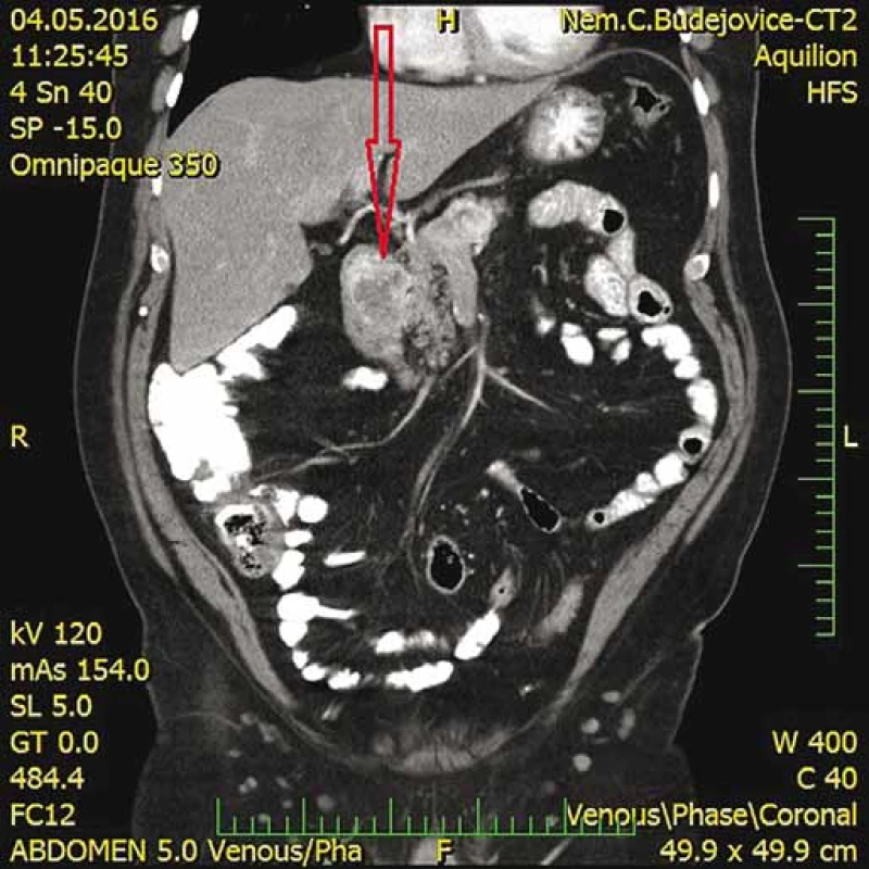 CT s nálezom metastázy v hlave pankreasu infiltrujúcu
duodenum (šipka).<br>
Fig. 7. CT scan shows metastases in the pancreas infiltrating
the duodenum (arrow).