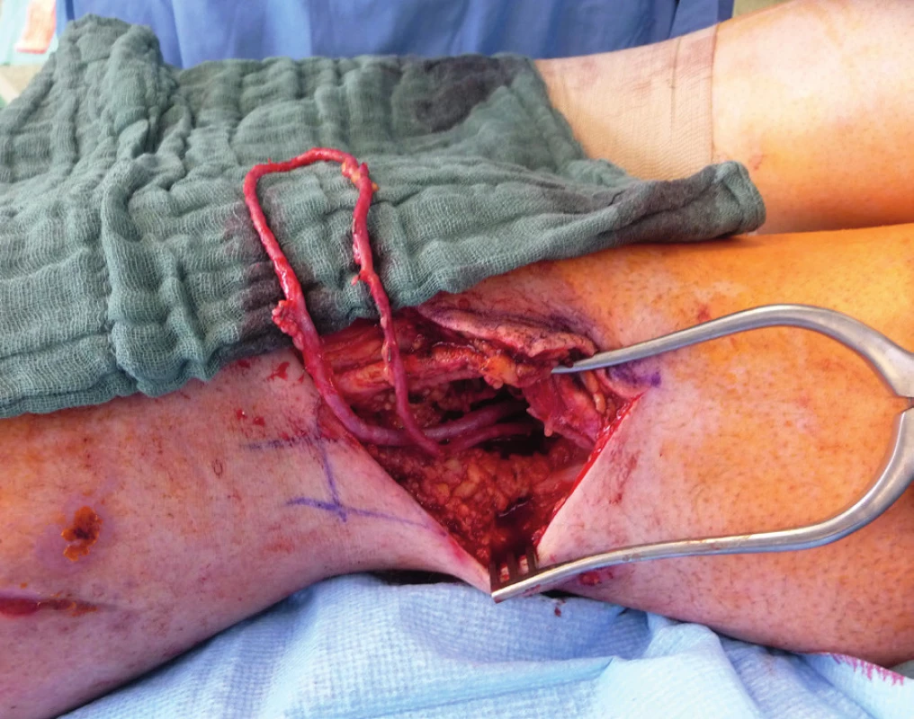The pedicle of ALT flap and stent placement in popliteal
artery justify the use of Corlett loop (temporary AV–shunt)