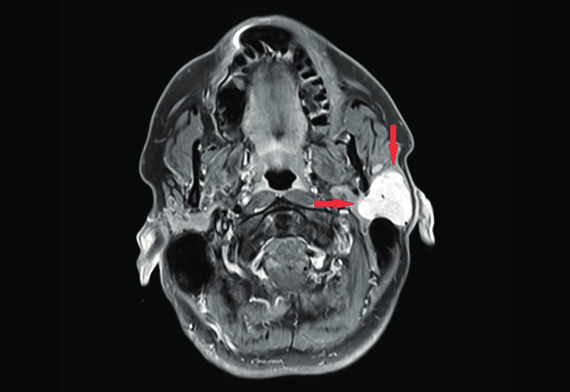 MRI – šípkami je označený dobre ohraničený nádor
s homogénnym post-kontrastným sýtením, lokalizovaný v povrchovej
časti ľavej príušnej slinnej žľazy.