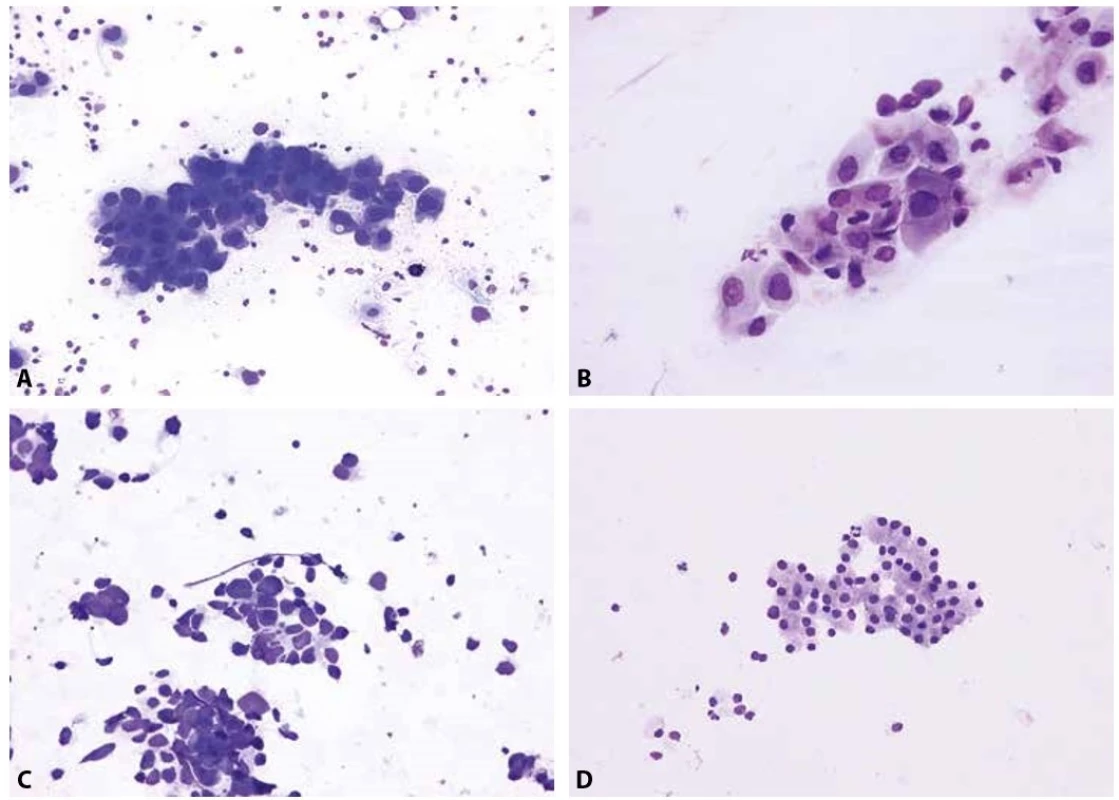 Základní diagnostické jednotky maligních epitelových nádorů plic.<br>
A – metastatický adenokarcinom s excentricky umístěnými jádry a místy patrnou vakuolizací cytoplazmy (EBUS-FNA mediastinální lymfatické uzliny; Diff-
-Quik®, 400x)<br> B – otisk excize endobronchiálně rostoucího dlaždicobuněčného karcinomu s denzní plachtovitou cytoplazmou a nepravidelnými jádry s hrubým
chromatinem (Diff-Quik®, 400x)<br> C - metastáza malobuněčného karcinomu, charakteristického skupinkami menších buněk s úzkým cytoplazmatickým lemem
a arteficiální deformací jader (perkutánní tenkojehlová aspirace subklavikulární lymfatické uzliny; Diff-Quik®, 400x)<br> D – karcinoid bronchu - poměrně uniformní
buňky s bazofilní jemně granulární cytoplazmou, tvořící trabekuly (rozlišení mezi typickým a atypickým karcinoidem není z cytologického vyšetření možné)
(nátěr z endobronchiálního aspirátu; Giemsa, 200x)