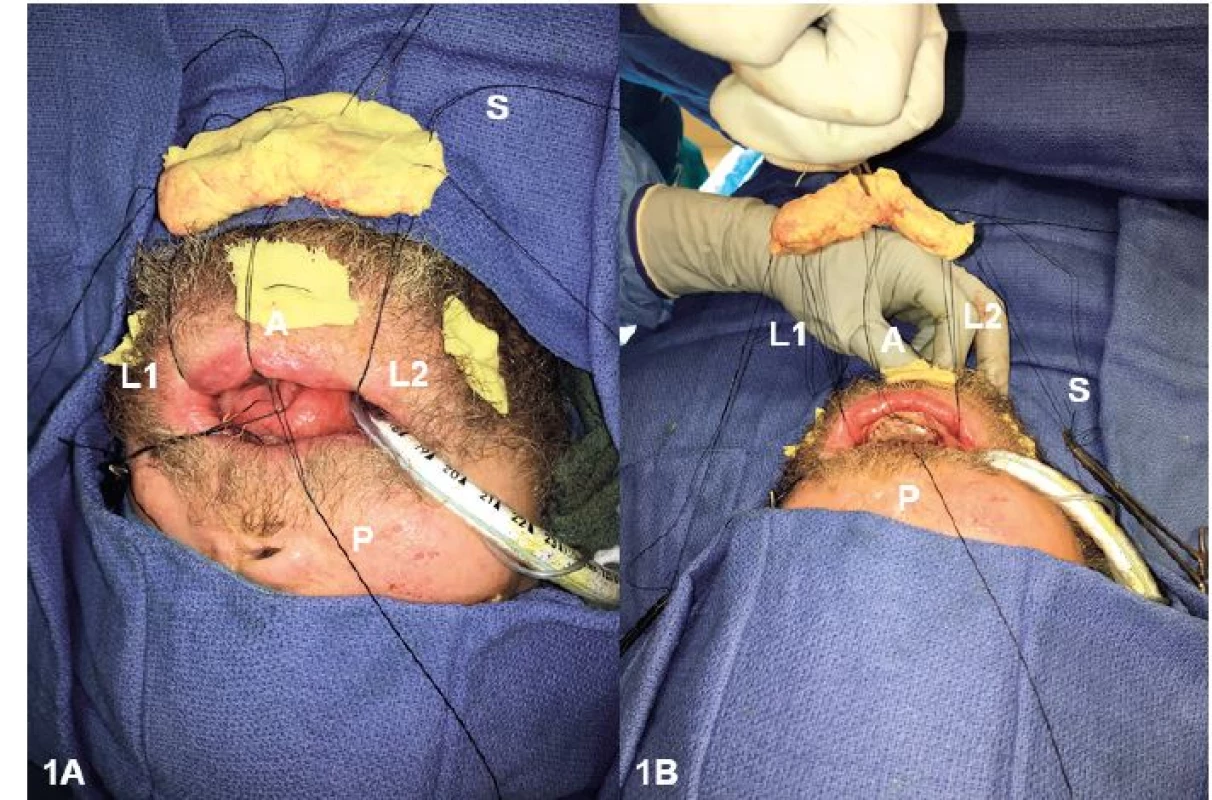 (A, B) Application of the intraoral bolster. The bolster was secured using 2-0 silk-tie-over sutures at the anterior (A), posterior (P),
and lateral (L1, L2) poles. A safety suture (S) was passed through the bolster